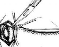 泪囊鼻腔吻合术视频,泪囊鼻腔吻合术操作步骤及要点解析
